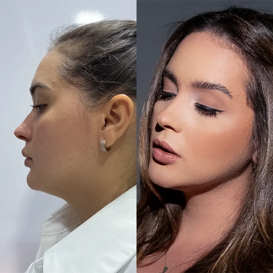 Antes e Depois